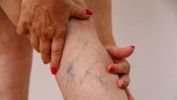 Не кръстосвайте крака, ако имате разширени вени