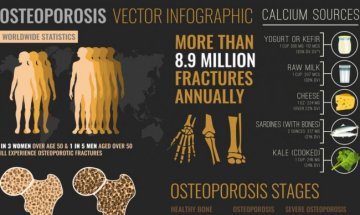 76% от жените над 50 години у нас не получават навременно лечение за остоепороза