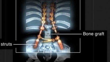 Ампутираха краката на дете, за да спасят гръбначния му стълб 